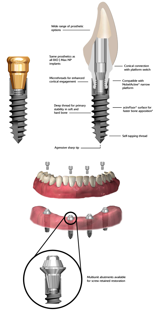 Bio | Max Mini Implants - Blue Sky Bio