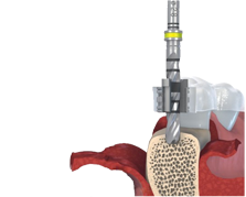 BIO Cut implant setting